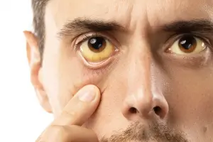 Causes Of Cataract Brown or Yellowish Eyes